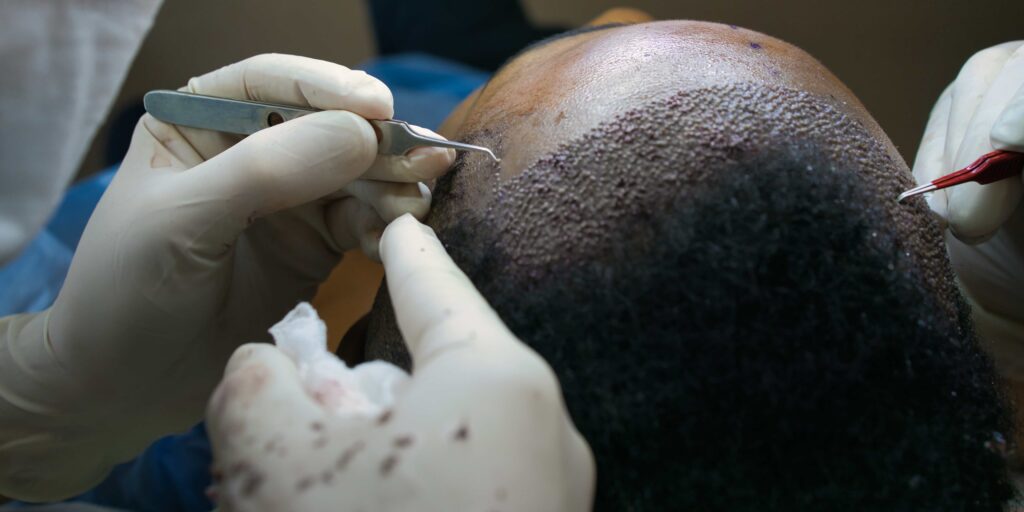 Hair Transplant In Bhubaneswar