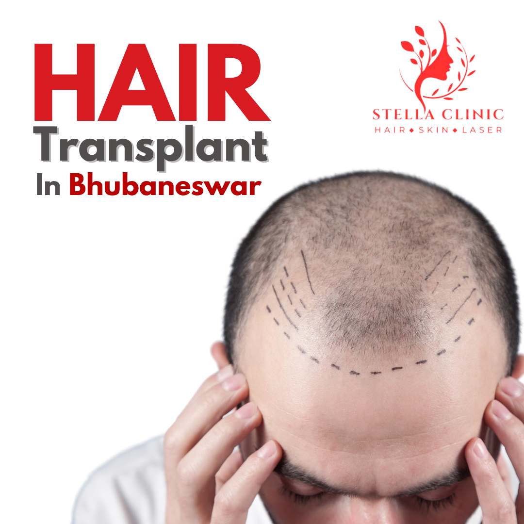 Hair Transplant In Bhubaneswar Stella Hair And Skin Clinic