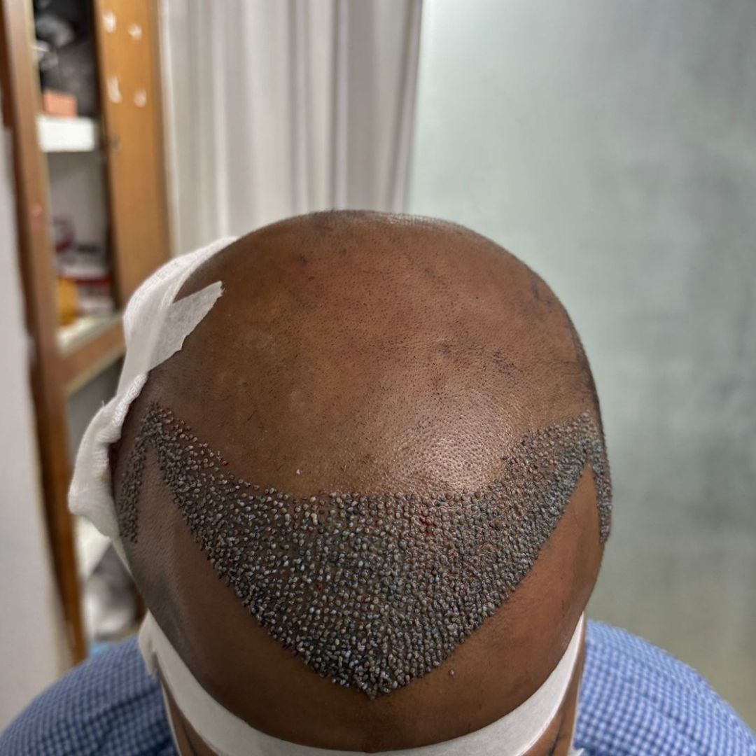 Hair Transplant In Bhubaneswar