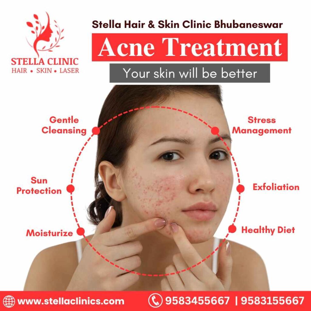 Acne Treatment Stella Hair And Skin Clinic Bhubaneswar