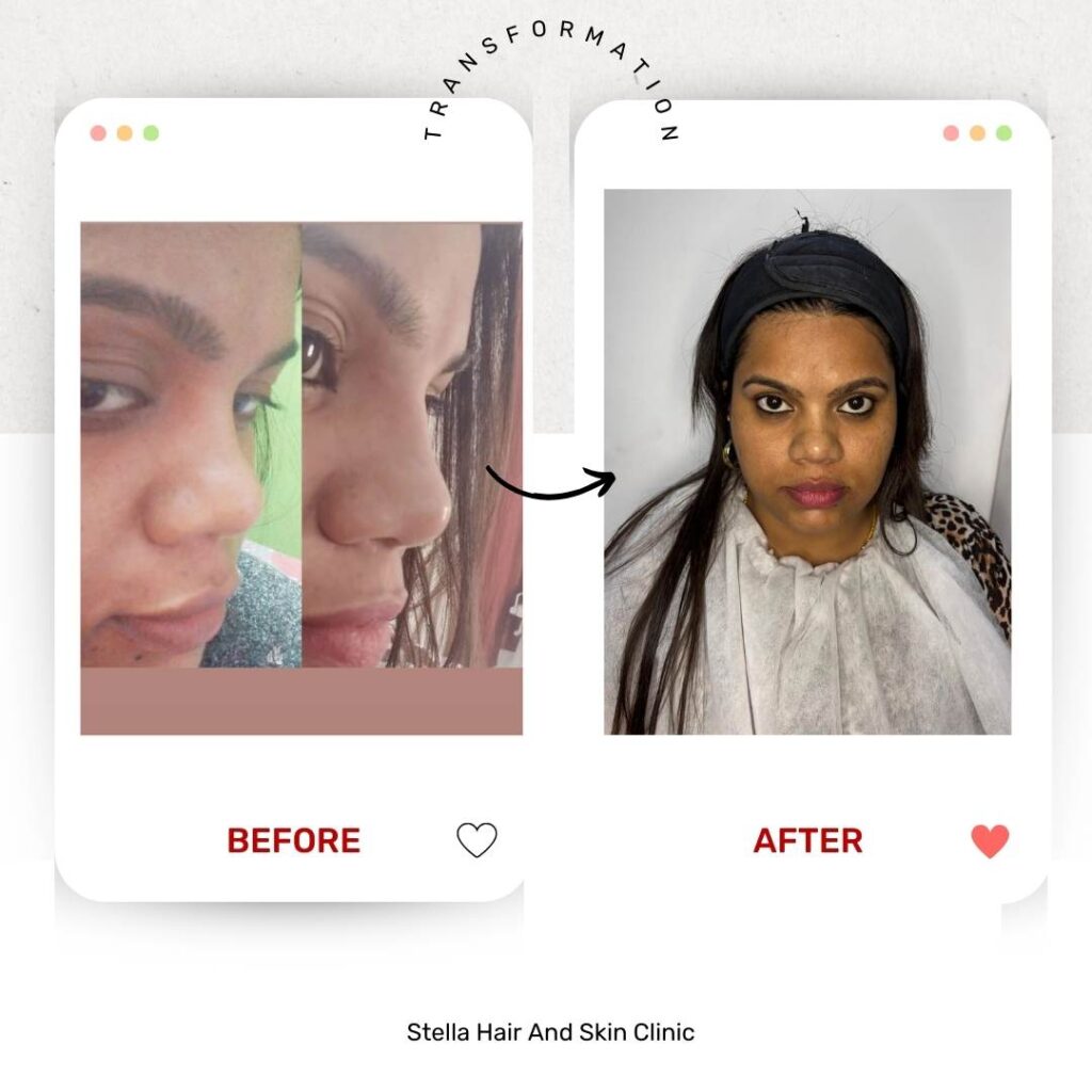 Liquid Rhinoplasty in Bhubaneswar