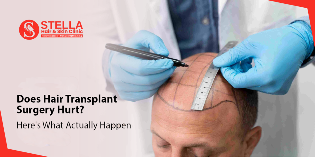 Does Hair Transplant Surgery Hurt? Here's What Actually Happens