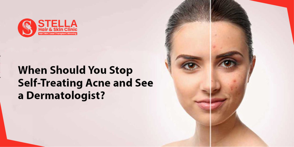 When Should You Stop Self-Treating Acne and See a Dermatologist?